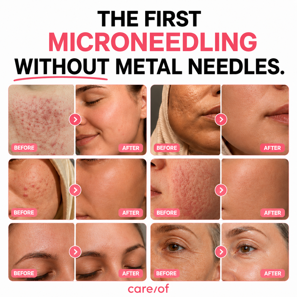 Bio-Microneedling Shots — Deep + Soft Set
