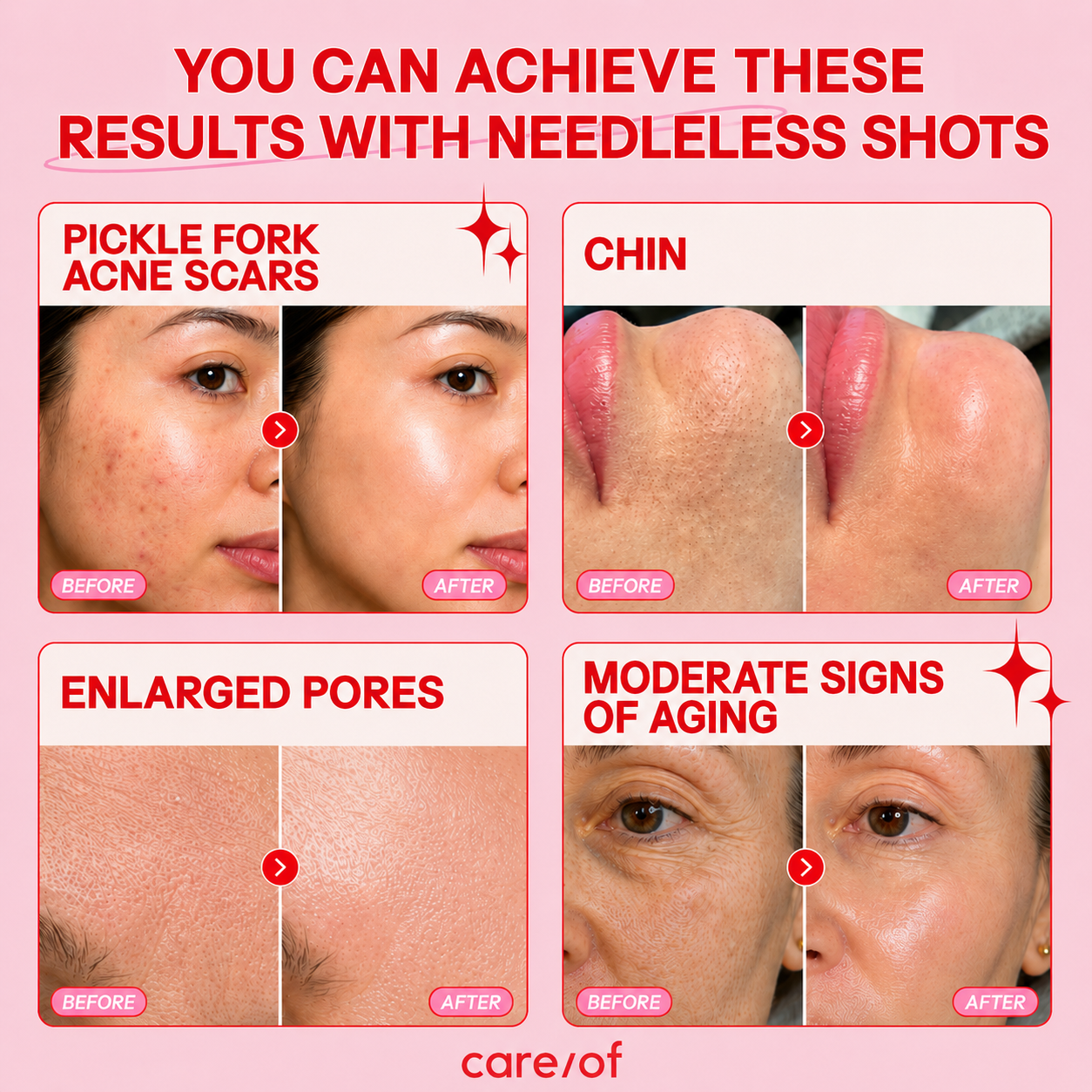 Bio-Microneedling Shots — Deep + Soft Set